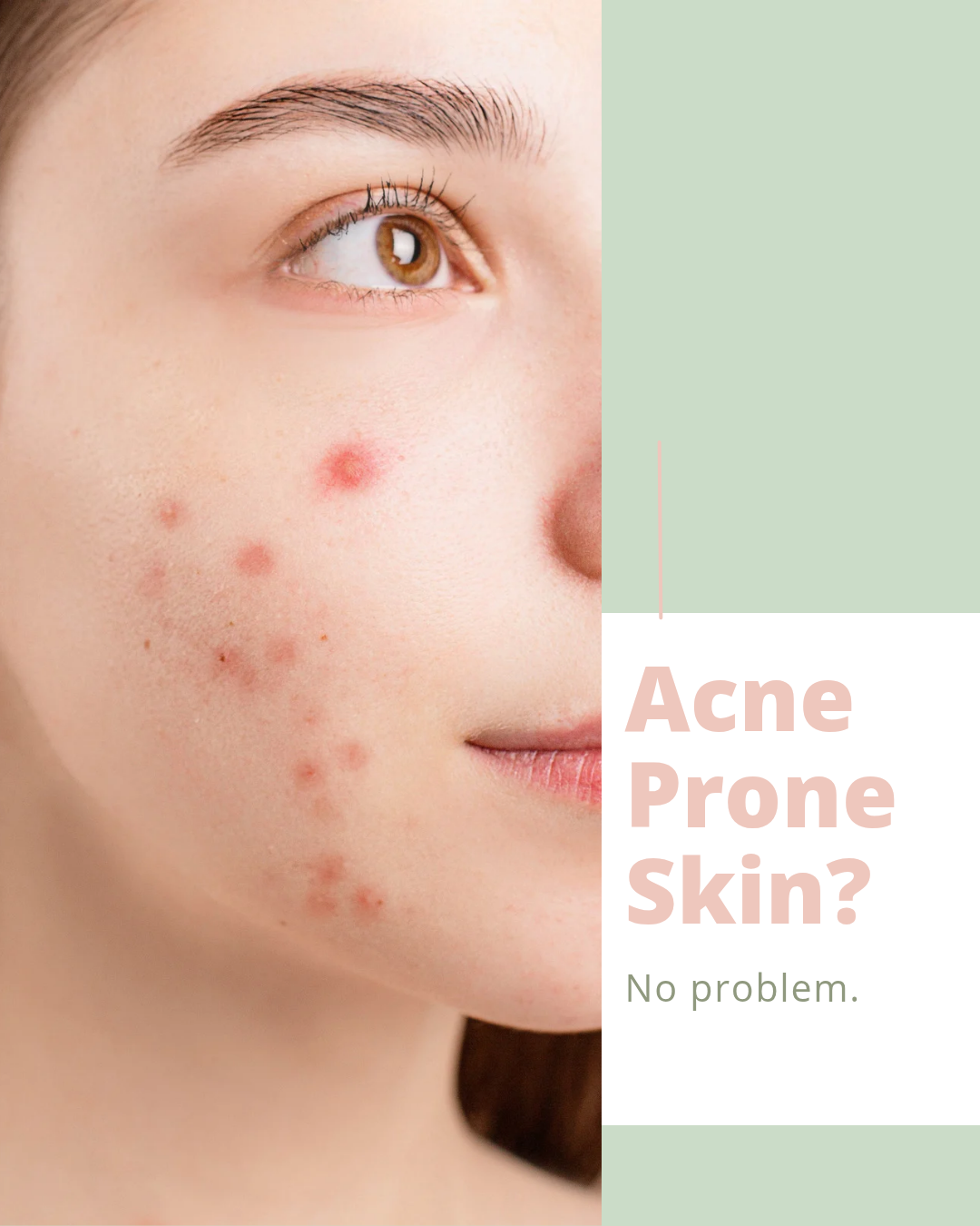 The Best Type of Exfoliation for Acne-Prone Skin